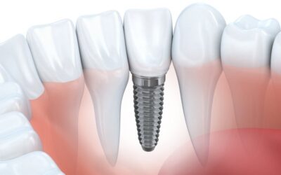 Dental Implants