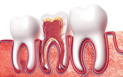 Root Canals