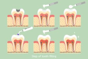 dental filling steps diagram
