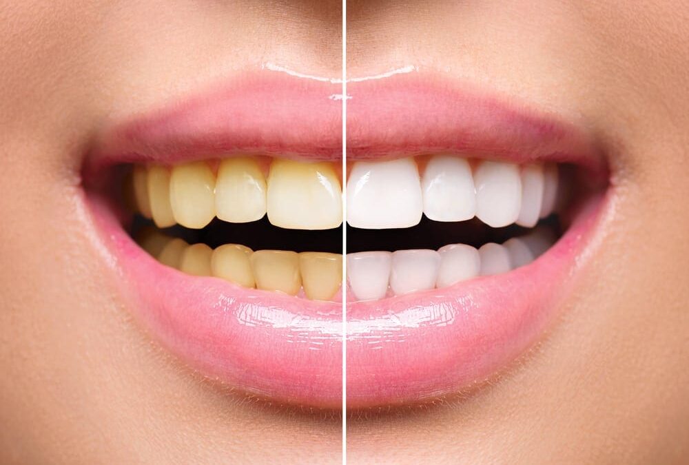 Teeth Whitening
