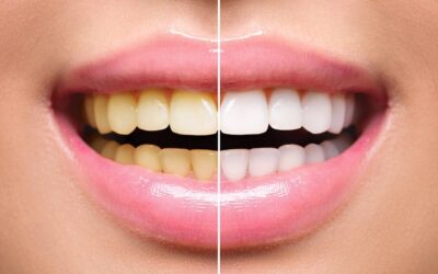 Teeth Whitening