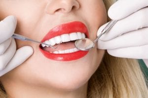 dental exam for veneers
