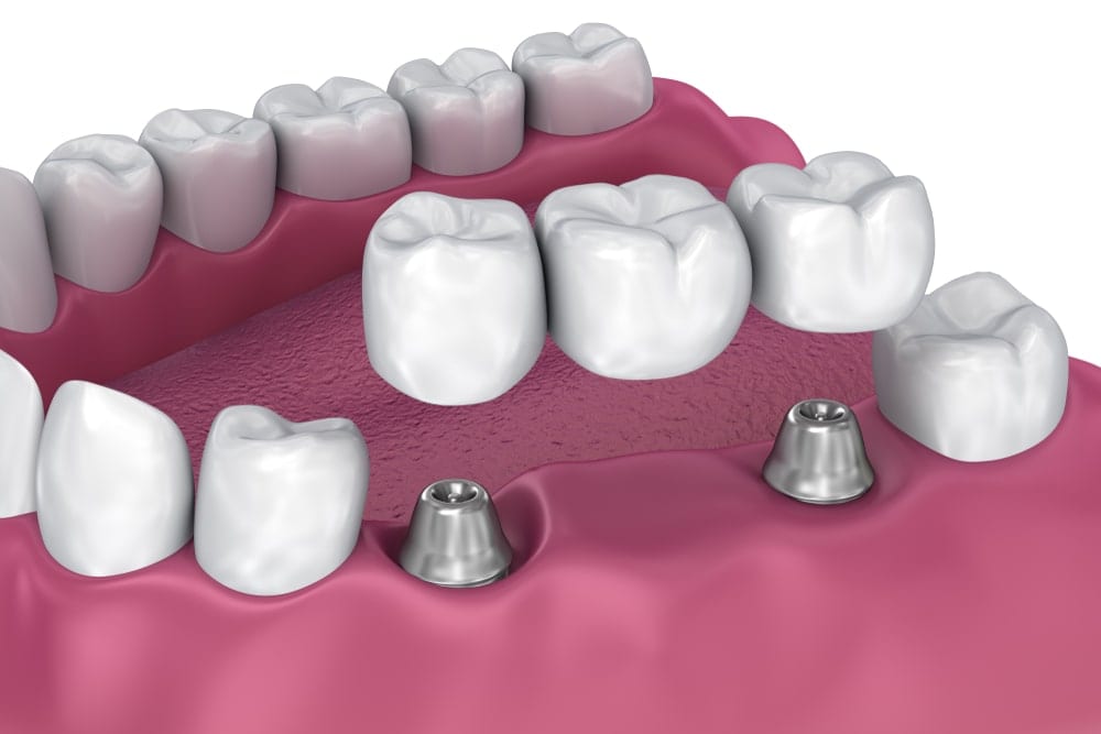 implant-supported dental bridge