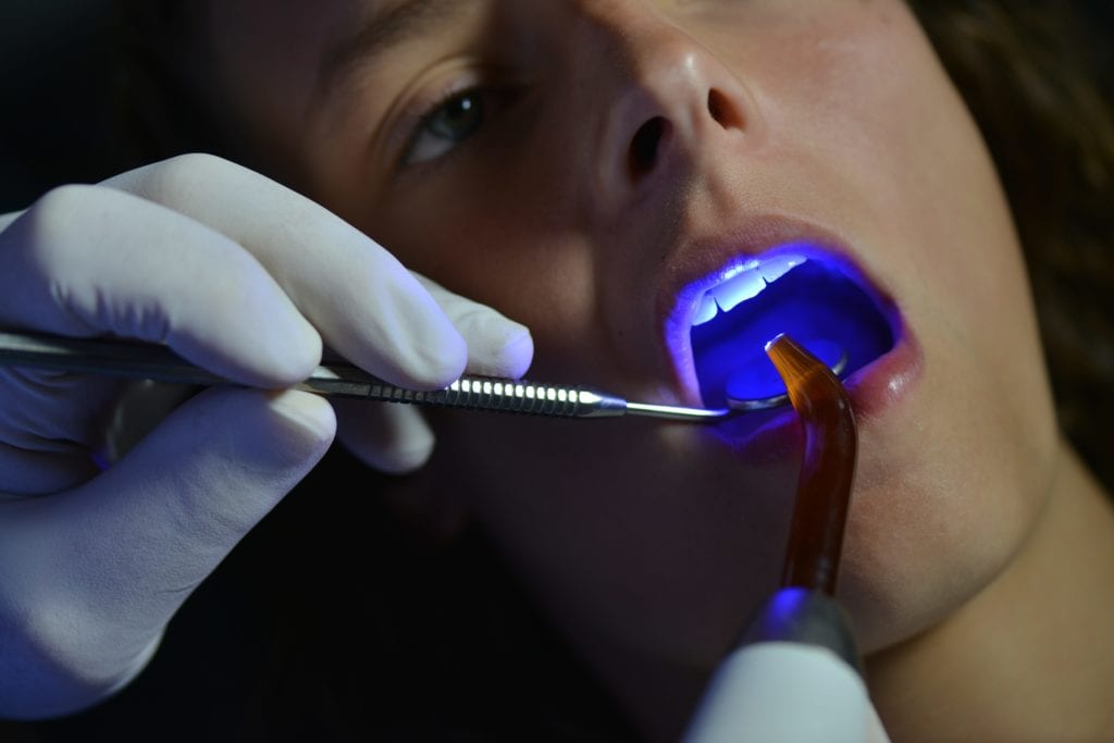 Man having composite resin in his mouth hardened with a curing light