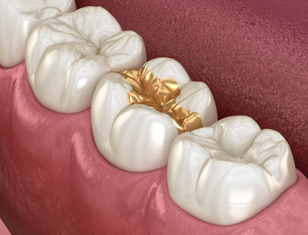 gold dental inlay