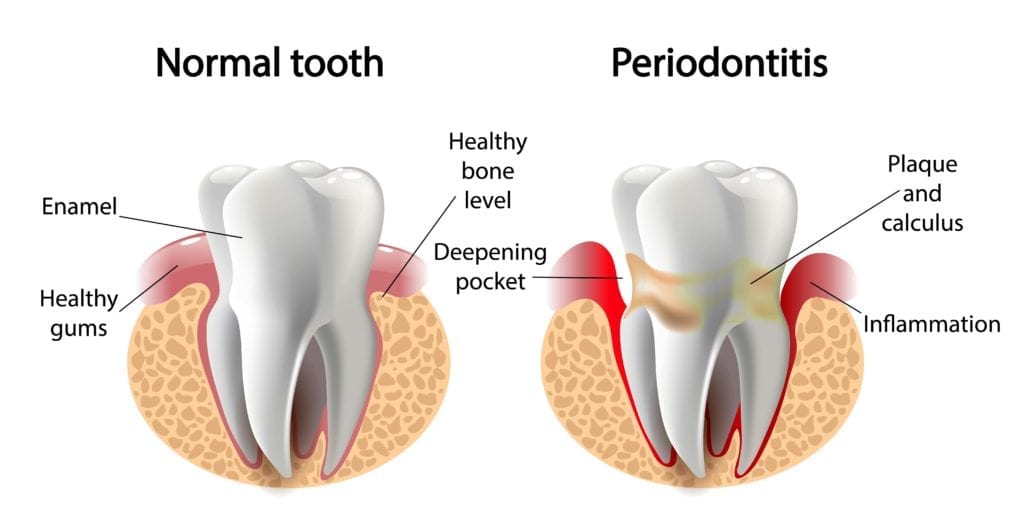 normal tooth vs. tooth surrounded by gums affected by periodontitis